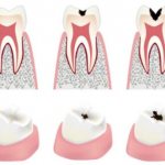 3 stages of caries development