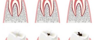 3 stages of caries development