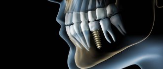 3D CT jaw