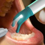 dental anesthesia