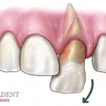 Autotransplantation of teeth