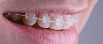 White arch braces