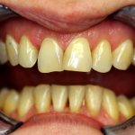 Metal-free crowns on teeth - photo before treatment