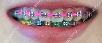 braces with colored rubber bands