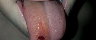 A common cause of pain is damage to the tip of the tongue.