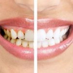 Teeth cleaning with Air Flow or ultrasound: which is better?