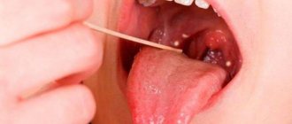 What to do if the root of the tongue hurts when swallowing, why does this happen?