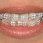 what are inspire ice sapphire braces, their photos