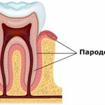 Что такое пародонт и пародонтология