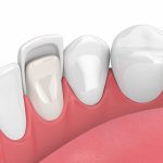 What are veneers and what are they made from?