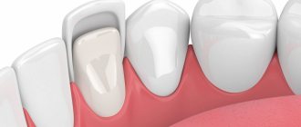 What are veneers and what are they made from?