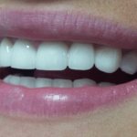 zirconium crowns for implants