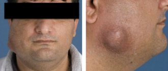 Facial deformity in maxillofacial actinomycosis