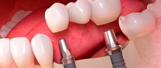 Dental implantation