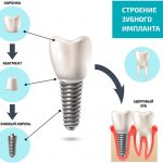 Дентальная одномоментная имплантация зубов