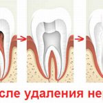 Tooth removal and prosthetics