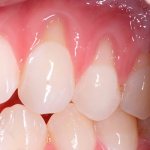 gum moving away from tooth photo