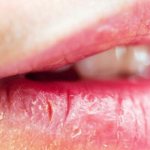 exfoliative cheilitis