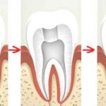 stages of nerve removal