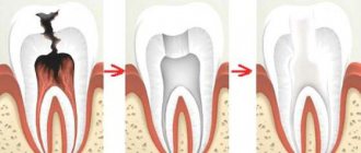 stages of nerve removal