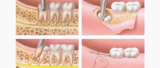 Stages of tooth extraction in parts in pictures