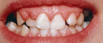 fibromatosis of the gums