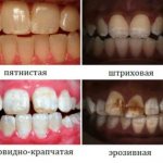 dental fluorosis