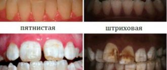 dental fluorosis