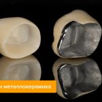 Photos of zirconium and metal-ceramic crowns