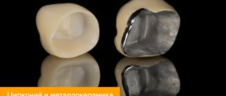 Photos of zirconium and metal-ceramic crowns