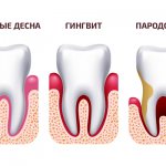 Photos of the stages of development of periodontitis in pictures