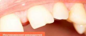 Photo of isolated microdentia