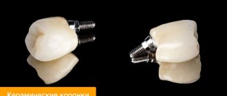 Photos of ceramic crowns on implants