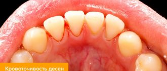 Photo of bleeding gums