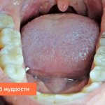 Photo of lower wisdom tooth