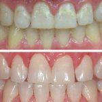 Photo of the patient before and after caries treatment without drilling