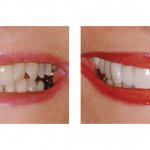Фото пациента до и после установки люминиров на зубы