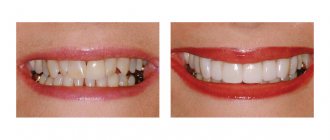 Фото пациента до и после установки люминиров на зубы