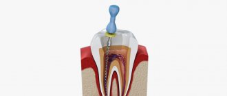 Photo of the process of removing a nerve from a tooth canal with pulpitis