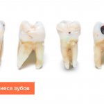 Photos of stages of dental caries