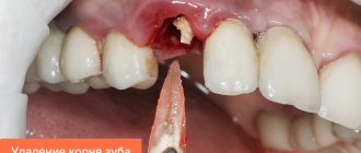 Photo of tooth root removal