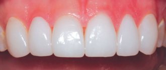 Photos of installed veneers