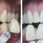 Photos of teeth before and after whitening