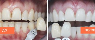 Photos of teeth before and after whitening