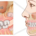 maxillary sinuses