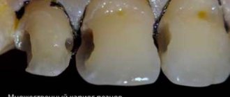 Where is caries located under braces?