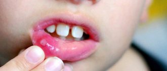 Herpetic stomatitis in a child