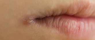 Cheilitis types