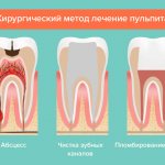 Хирургический метод лечения пульпита в картинках