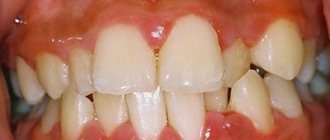 Chronic periodontitis